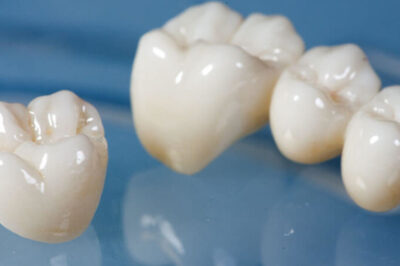 Dental Crowns: Uses, Procedure, and Maintenance
