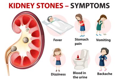 Crystalline Agony: A Comprehensive Guide to Kidney Stone Signs and Symptoms