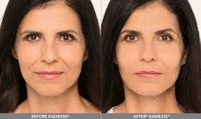 A Comprehensive Guide to Radiesse Jaw Enhancement Treatment Process